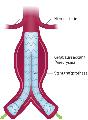 aneurysma stenteinlage