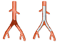 y-prothese